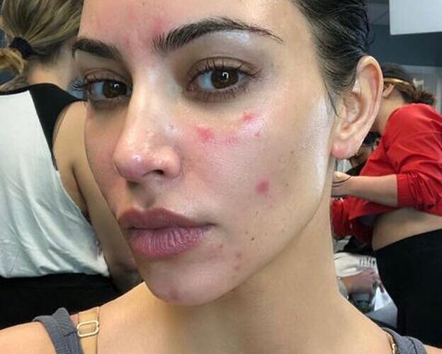 Psoriasis: la enfermedad del estrés y la ansiedad que padece Kim Kardashian