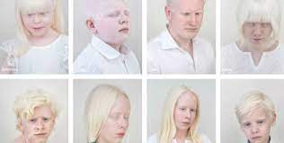 Día internacional de sensibilización sobre el albinismo: Consecuencias cutáneas de los albinos