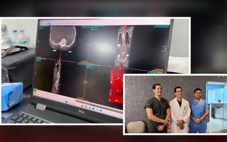 Realizan primera cirugía en esclerosis con tecnología de realidad aumentada en San Luis Potosí