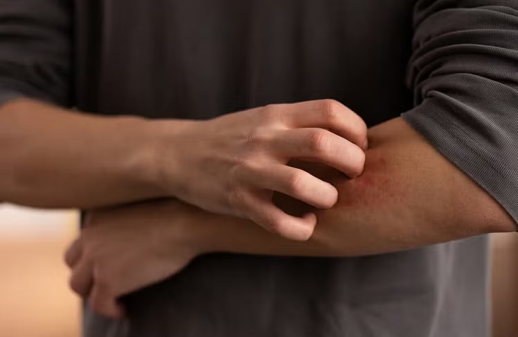 Confirman segundo caso de gusano barrenador en humanos; ahora fue en un hombre de 50 años