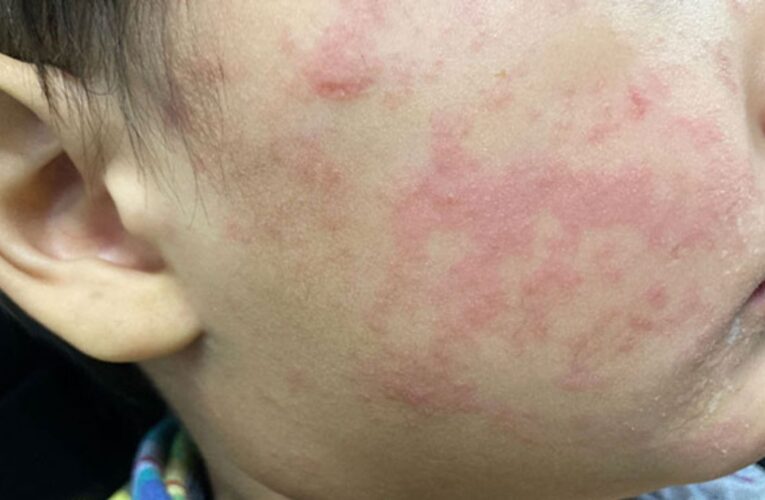 Casos de sarampión se extienden a 25 estados