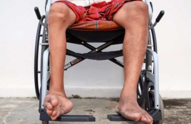 Poliomielitis, enfermedad viral que afecta nervios de médula ósea