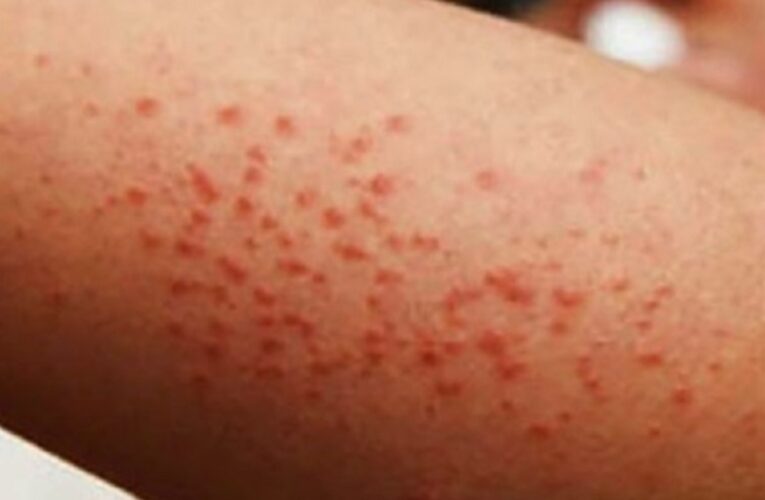 Morelos detecta 13 casos importados de sarampión; suman 5 mil a nivel nacional