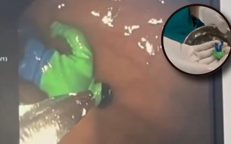 Niño tenía un fuerte dolor y médicos descubren un “Hulk” en el estómago